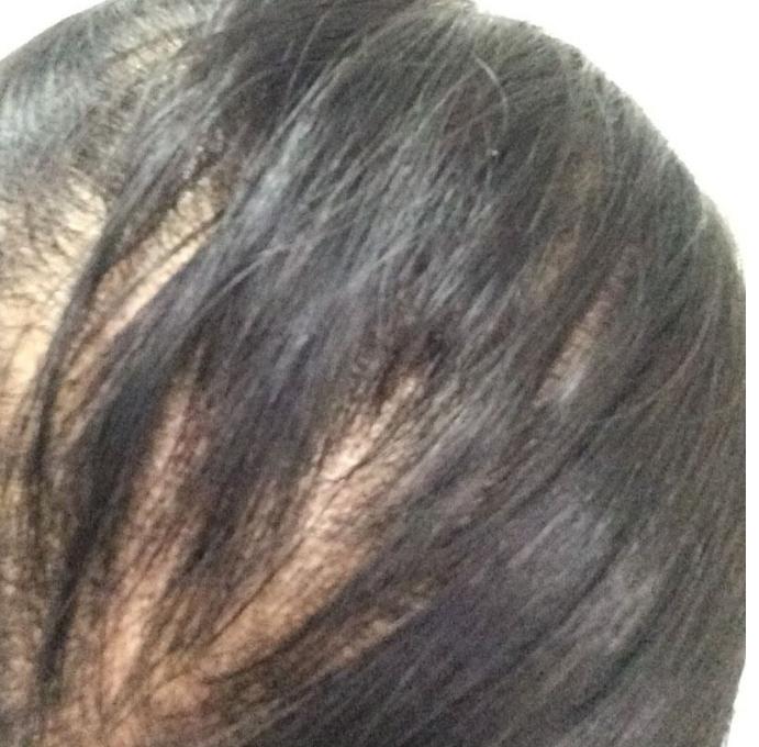 非那雄胺治疗脱发过程,记录治疗脱发每一天