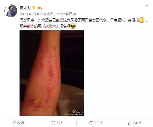 完全没想到!明星也如此痴迷刮痧和拔火罐…