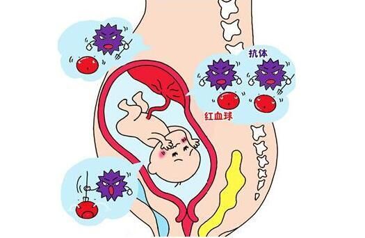 o型血的妈妈要警惕abo溶血症,abo溶血症产检时能不能查出