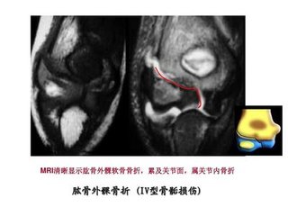 儿童骨骺受损后果严重吗,儿童损伤导致骨骺线闭合
