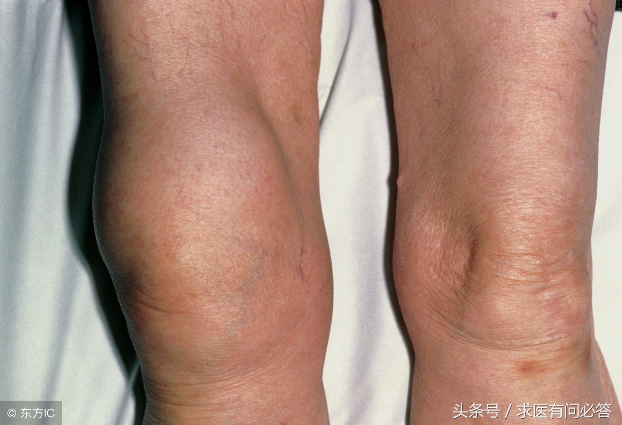 绒毛结节性滑膜炎饮食注意事项,痛风和滑膜炎饮食上应注意什么