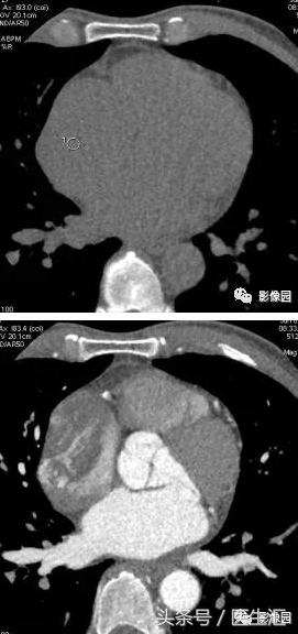 少见原发性心脏肿瘤