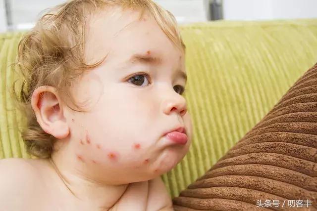 怎么去水痘留下的疤,水痘凹痕疤痕自然淡化时间
