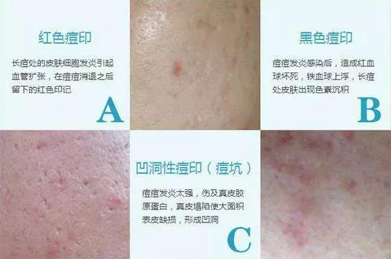 错误的祛痘印方法,错误的祛皱方法