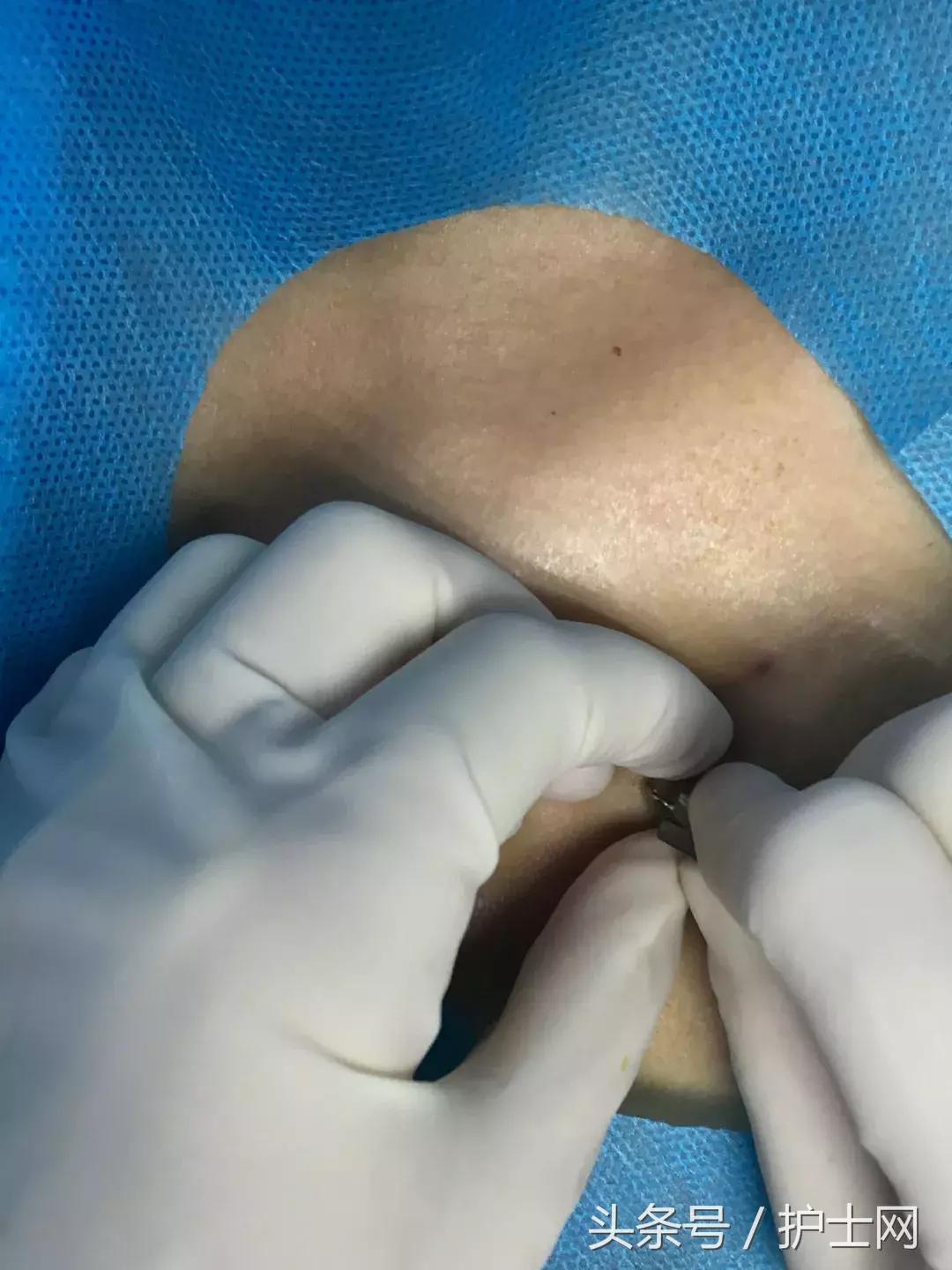 输液港扎针最全示范,输液港拔针的正确方法视频教程