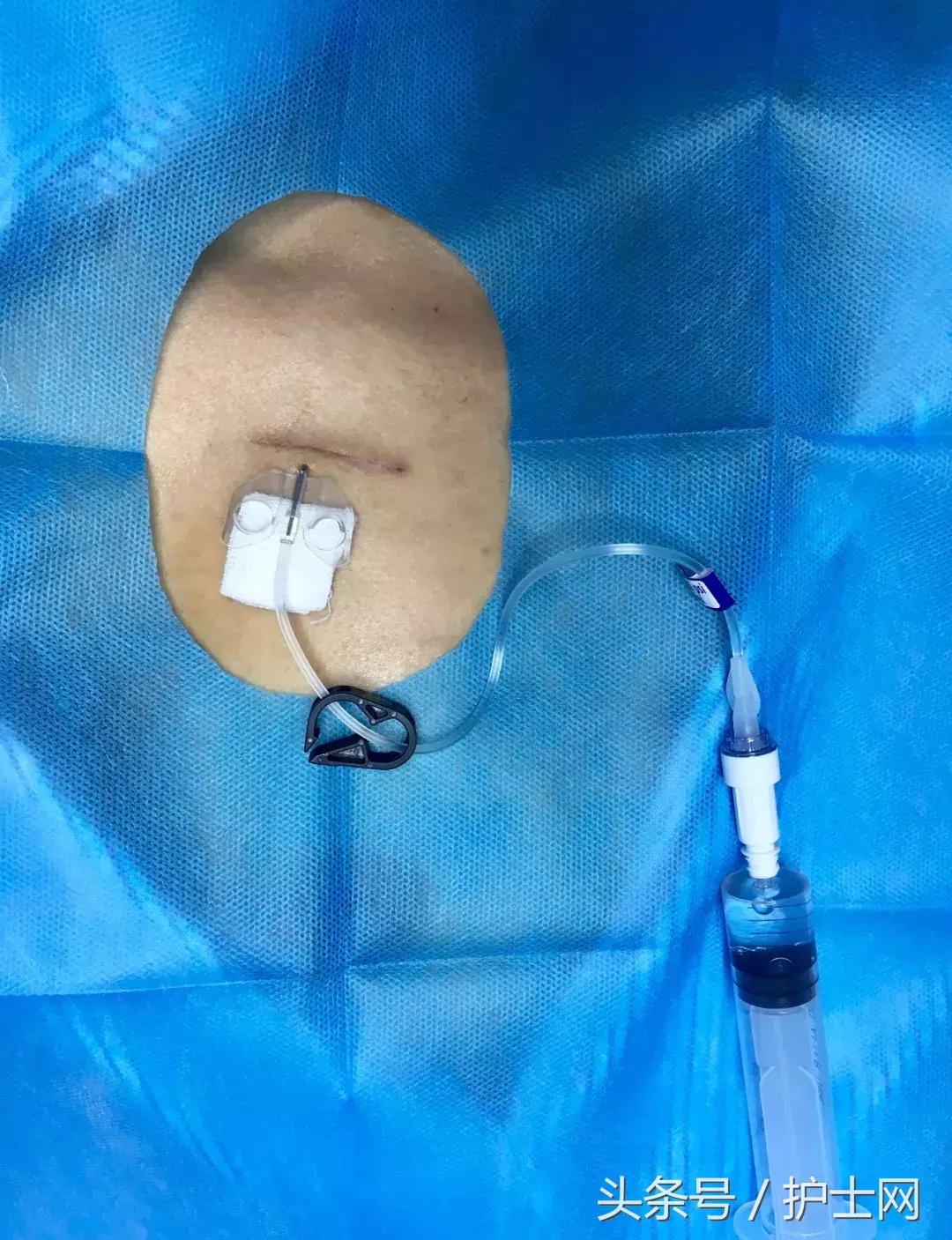 输液港扎针最全示范,输液港拔针的正确方法视频教程