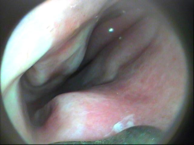 静子谈养生,中医治疗鼻炎方法有哪些