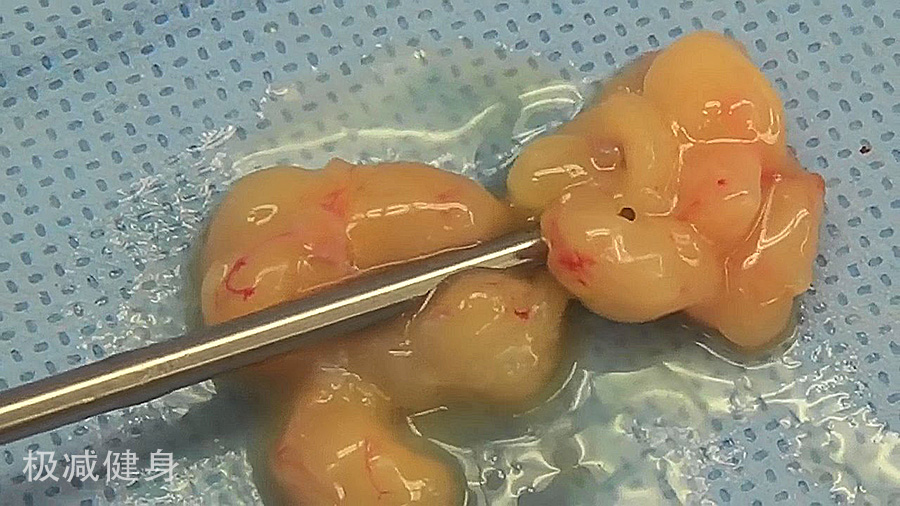 减肥抽脂的过程是怎样的,抽脂减肥的危害亲身经历