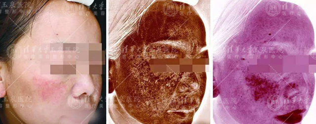 褐斑有几种,褐青色斑什么原因