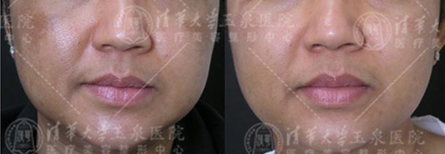 褐斑有几种,褐青色斑什么原因