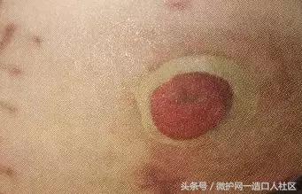 肠造口并发症——造口周围线结反应