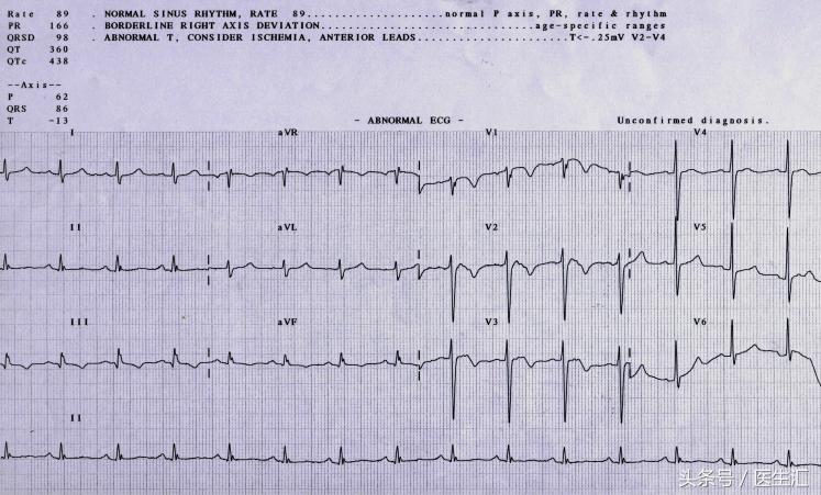 肺血栓栓塞溶栓治疗药物,肺血栓栓塞溶栓手法