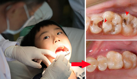 乳牙蛀牙只剩根部需要拔掉吗,为啥乳牙蛀牙10岁以后才换