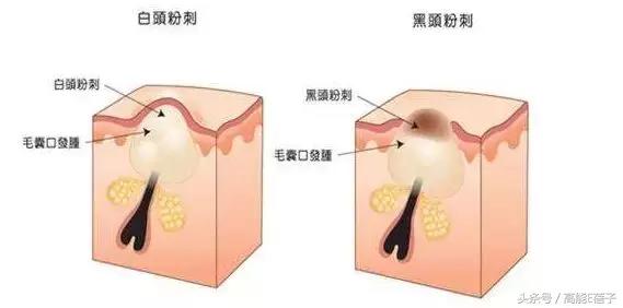 蔡徐坤、Angelababy都根治不掉的黑头，微商神器能去除？