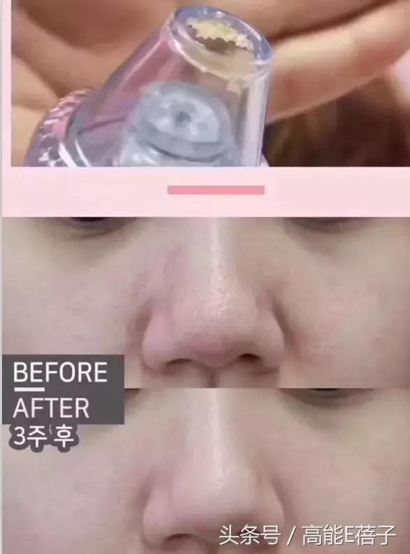 蔡徐坤、Angelababy都根治不掉的黑头，微商神器能去除？