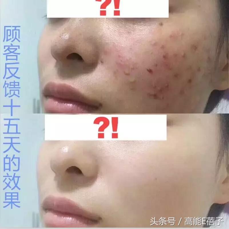 别傻了！蔡徐坤、Angelababy都根治不掉的黑头，微商神器能去除？