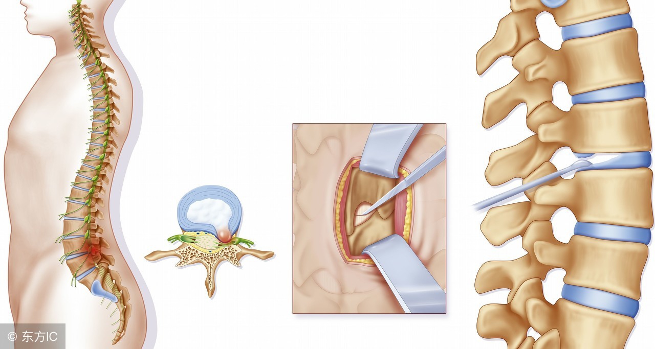 腰椎间盘4-5节突出做手术的效果,哪种情况的腰椎间盘突出要做手术