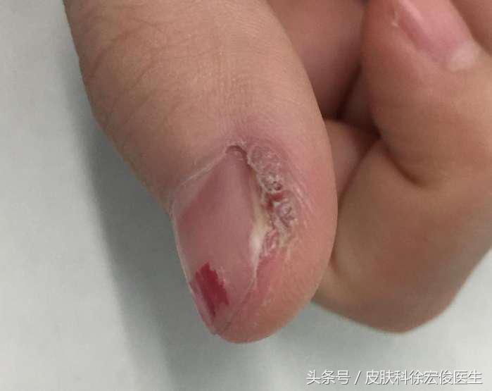 指甲变厚一定是灰指甲吗,不是灰指甲但是脚指甲变厚