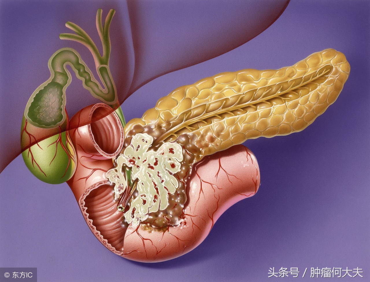 请问胰腺癌早期是什么症状啊,癌中之王胰腺癌怎么筛查