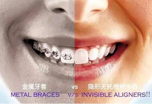 阿娇整牙,阿娇整牙前后对比