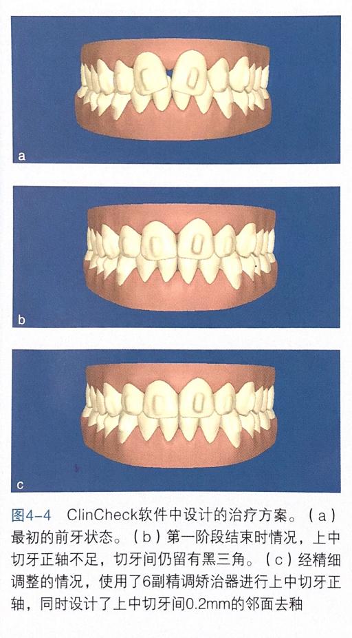牙齿上的黑三角怎么回事,牙齿上的黑三角怎么改善