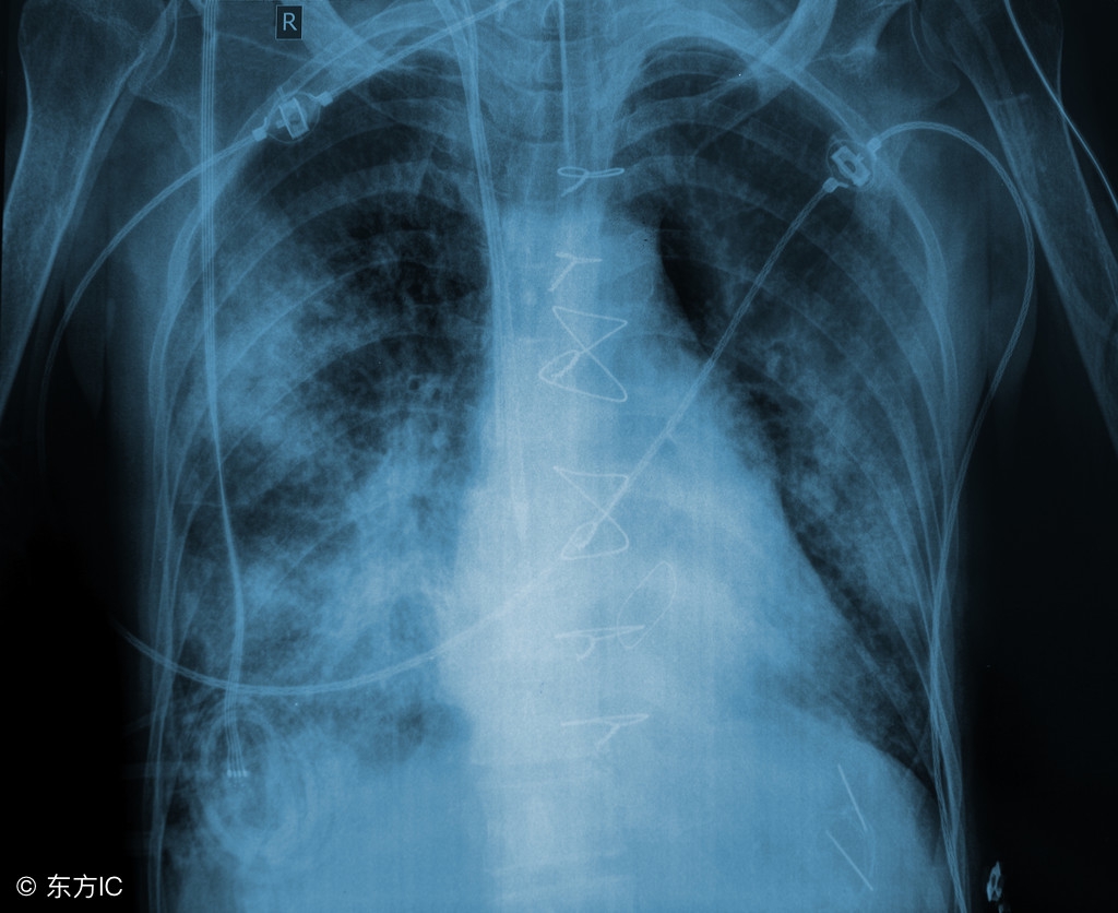 做胸片结果是胸纹理乱,做了胸片肺部上面有肿瘤