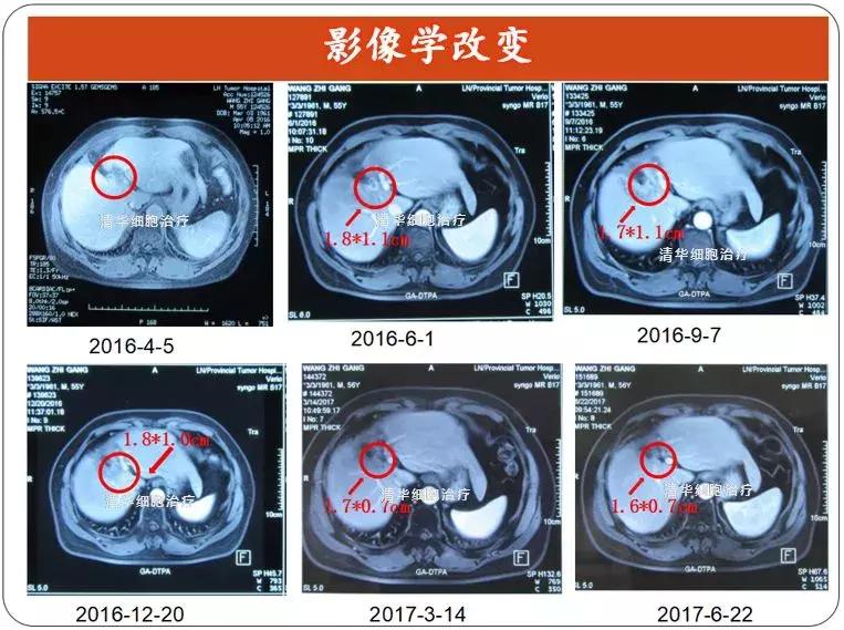 「肝胆管细胞癌，NKT治疗案例展示」清华NKT·乐和亲友·2016-43