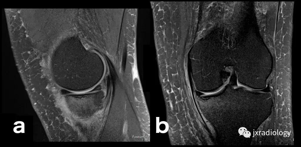 膝关节骨髓水肿疼痛特点,膝关节骨髓水肿的临床表现