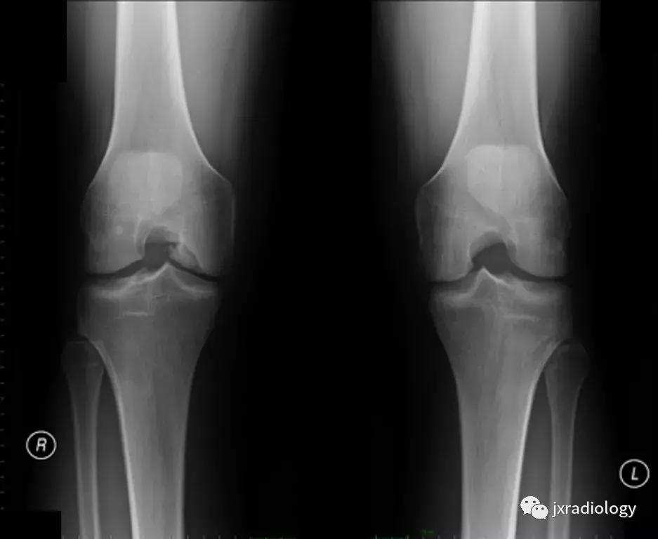 膝关节骨髓水肿疼痛特点,膝关节骨髓水肿的临床表现