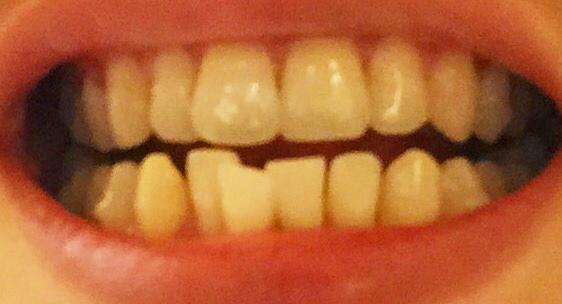 吹的乐器是不是对牙齿不好,吹乐器对牙齿有影响吗