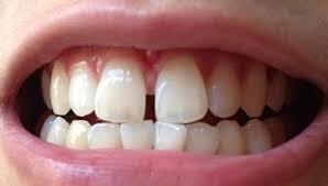 吹的乐器是不是对牙齿不好,吹乐器对牙齿有影响吗