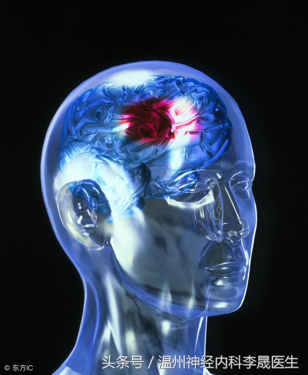 专家讲解中医治疗脑出血视频,医生对脑出血病人的治疗