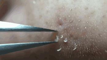 拔黑头粉刺过程细节,挤痘痘和拔黑头手法