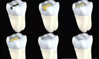 树脂补牙什么意思,树脂补牙是什么原因引起的