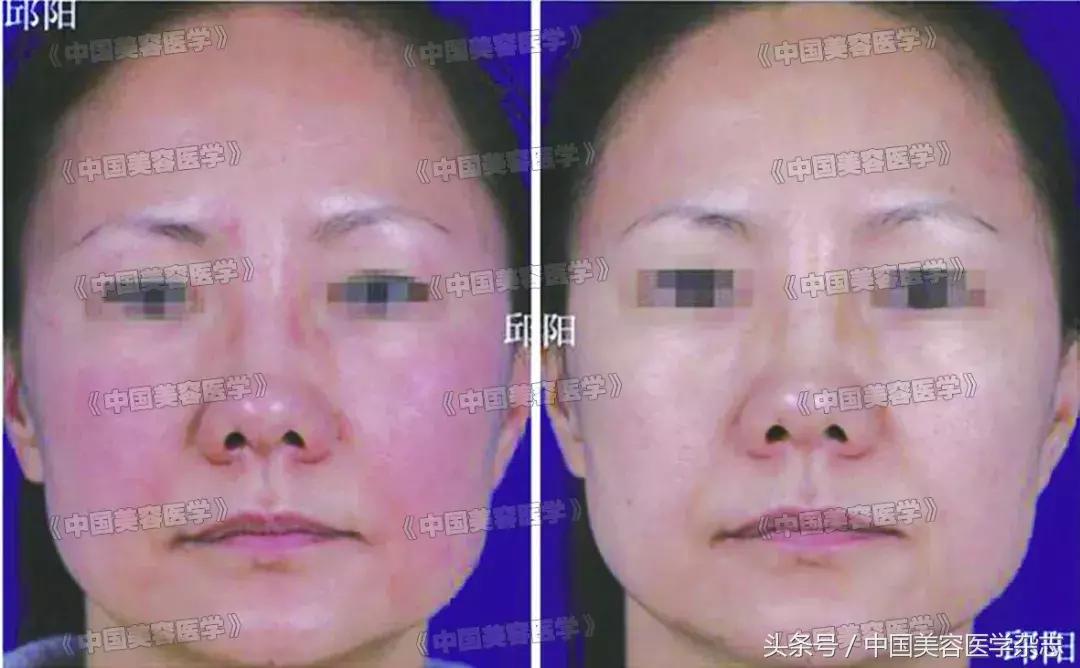 红脸蛋敏感肌怎么修复,怎么治疗泛红敏感肌