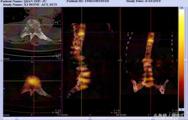 晚期乳腺癌病例,浸润性小叶乳腺癌3级