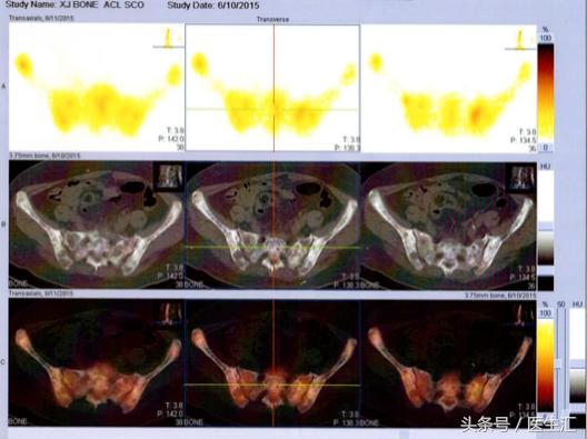 晚期乳腺癌病例,浸润性小叶乳腺癌3级