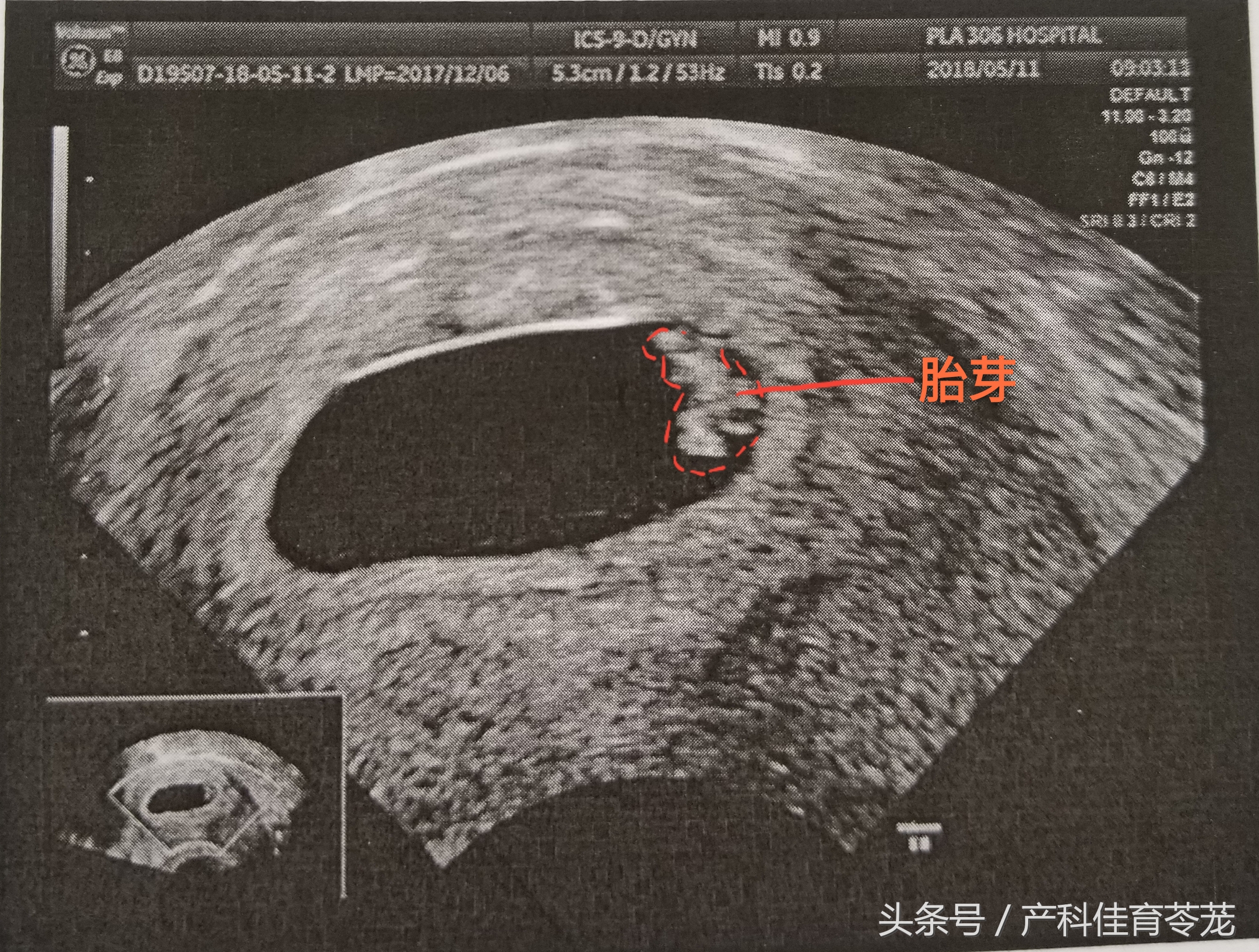 产科彩超报告解读,教您看懂产科超声报告