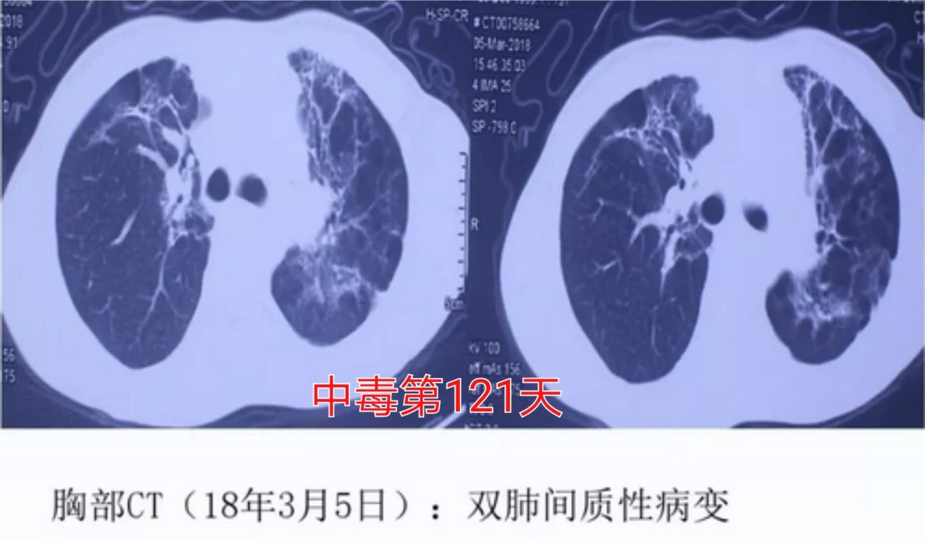 百草枯中毒救活成功率,百草枯中毒能救活吗