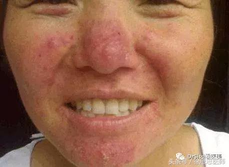 专业去除各种斑痘,专治脸上各种斑各种痘