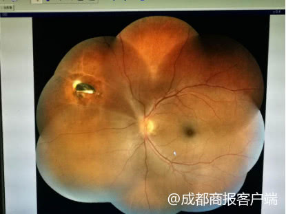 右眼被铁屑砸中后失明算重疾病吗,铁屑进了眼睛不取出来能恢复吗