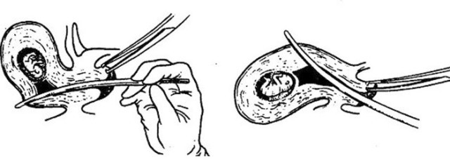 一次剖腹产二胎能顺产嘛,一次剖宫产和二次区别