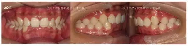 原来，上牙盖住下牙太多，也对牙齿有伤害！该怎么矫正？