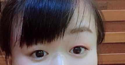 两女子在株洲爱思特万元割双眼皮后，都称“不敢见人”