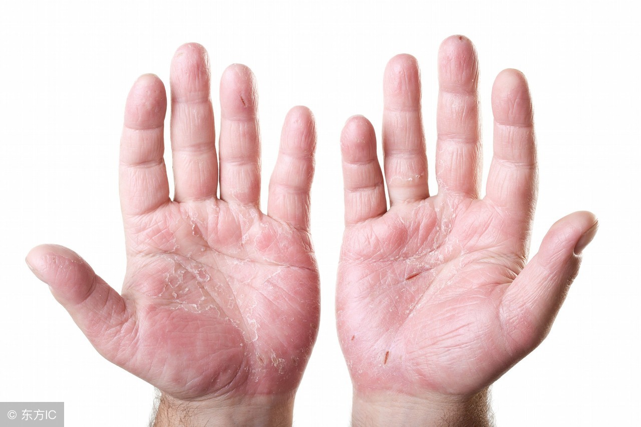 皮肤湿疹有哪些症状表现,皮肤湿疹的症状与特征