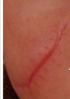 整形术后不冰敷,整形疤痕多久可以恢复