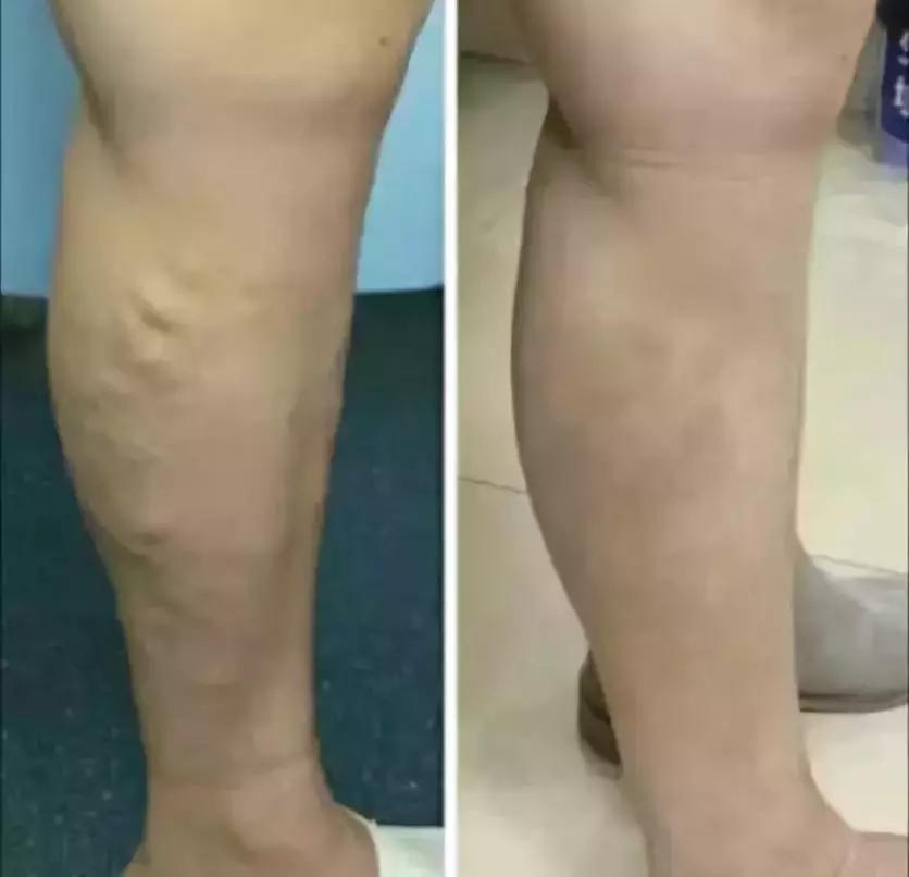 景德镇市第一人民医院开展全市首例大隐静脉曲张激光治疗术