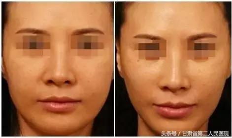 关于瘦脸针的知识解析,关于瘦脸的那些事