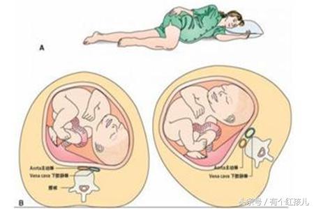 怎么预防宝宝脐带绕颈,预防脐带绕颈