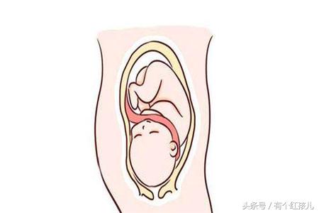 怎么预防宝宝脐带绕颈,预防脐带绕颈